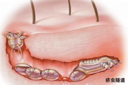 疥疮是怎么引起的（疥疮是怎么引起的图片）