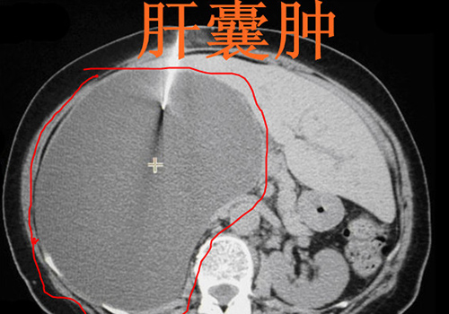 肝囊肿是怎么回事 肝囊肿是怎么回事?