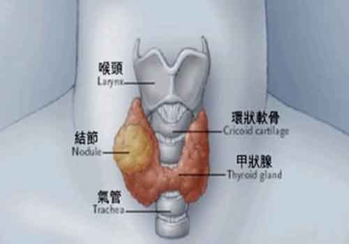 甲状腺结节能治愈吗（儿童甲状腺结节能治愈吗）