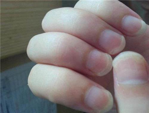 灰指甲传染吗（灰指甲传染吗?怎么样才会传染呢?）