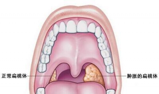 扁桃体发炎引起发烧怎么办？可以这样治疗