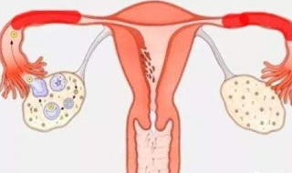 输卵管堵塞怎么办 需要手术解决问题