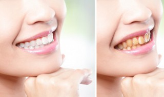牙菌斑怎么去除 牙结石牙菌斑怎么去除