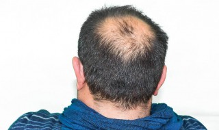 7种有效应对秃顶的方法是什么（如何解决秃头问题）