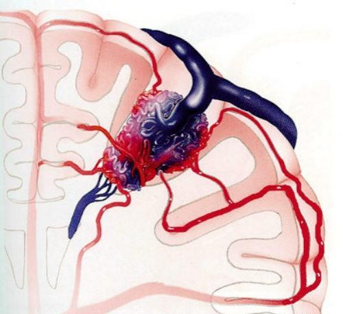 脑动静脉畸形 脑动静脉畸形介入手术后遗症