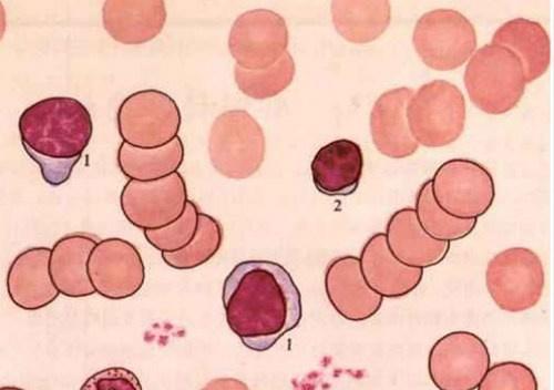球蛋白高是怎么回事 尿免疫球蛋白高是怎么回事