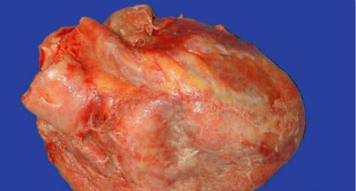纤维蛋白性心包炎 纤维蛋白性心包炎特异性的体征是