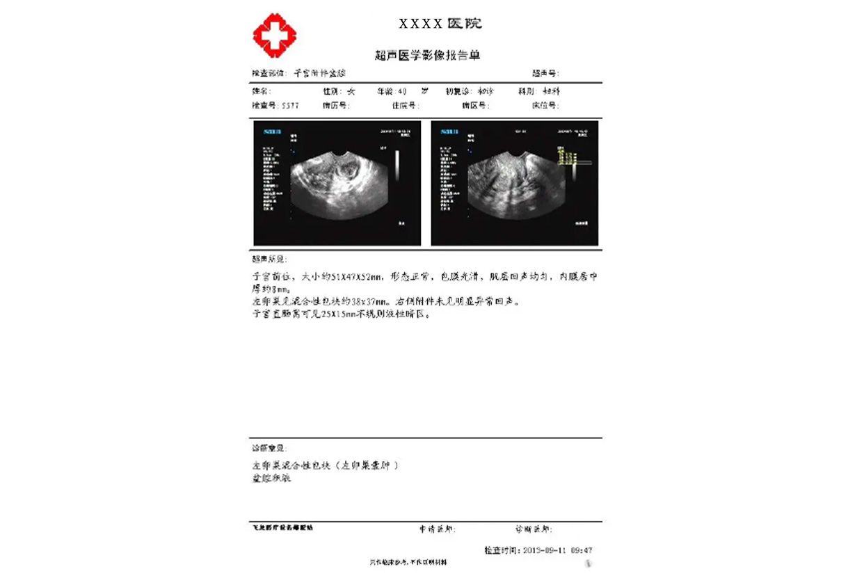 卵巢囊肿诊断证明图片 卵巢囊肿手术诊断证明书图片