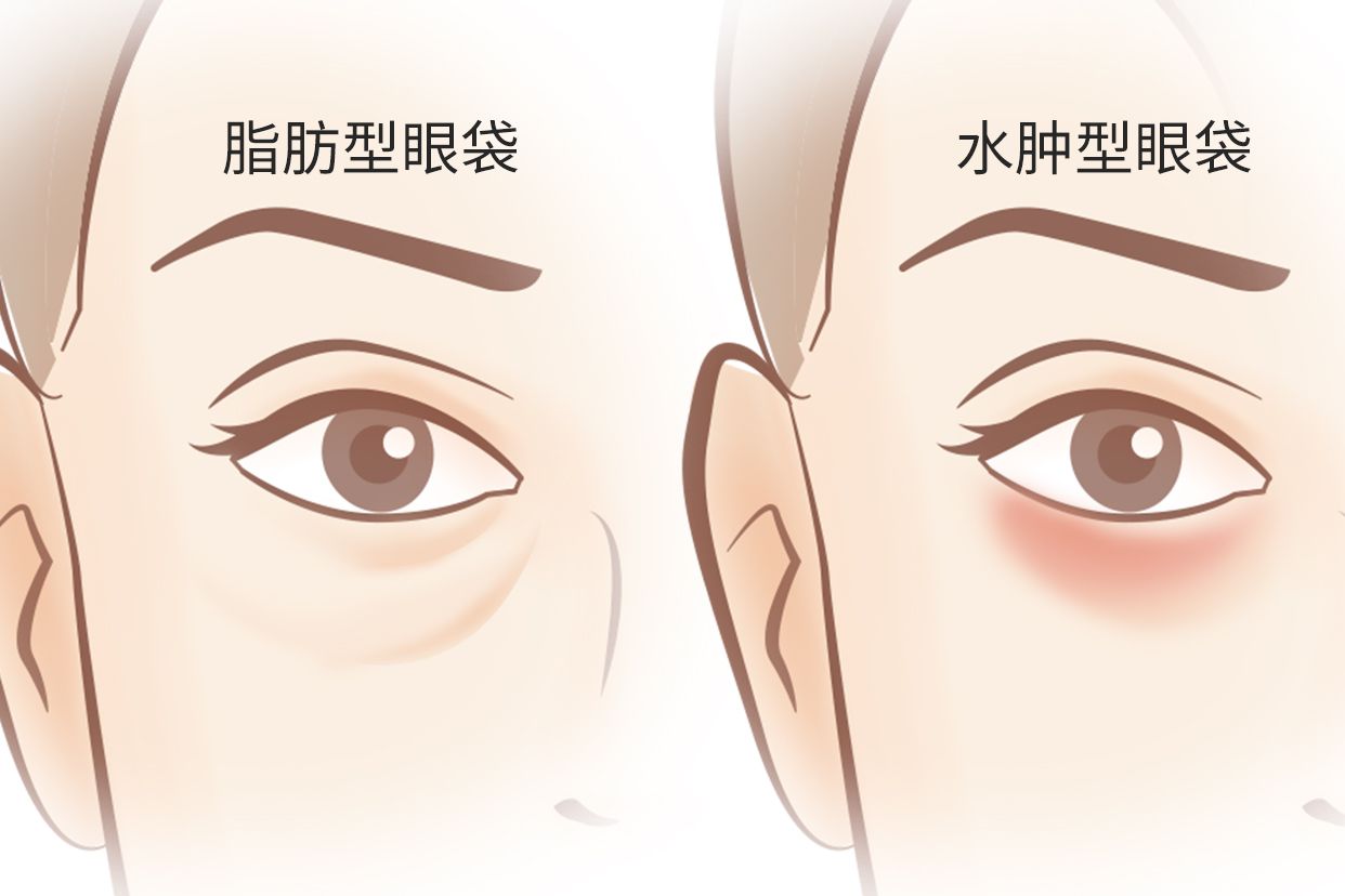 脂肪型眼袋和水肿型眼袋区别图（脂肪型眼袋和水肿型眼袋区别图片）