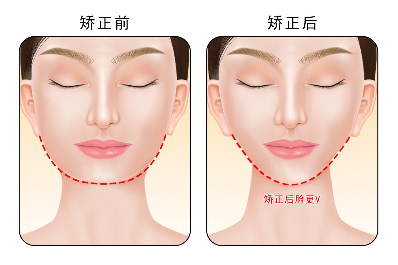 深覆盖矫正脸型变化图（深覆盖矫正脸变长）