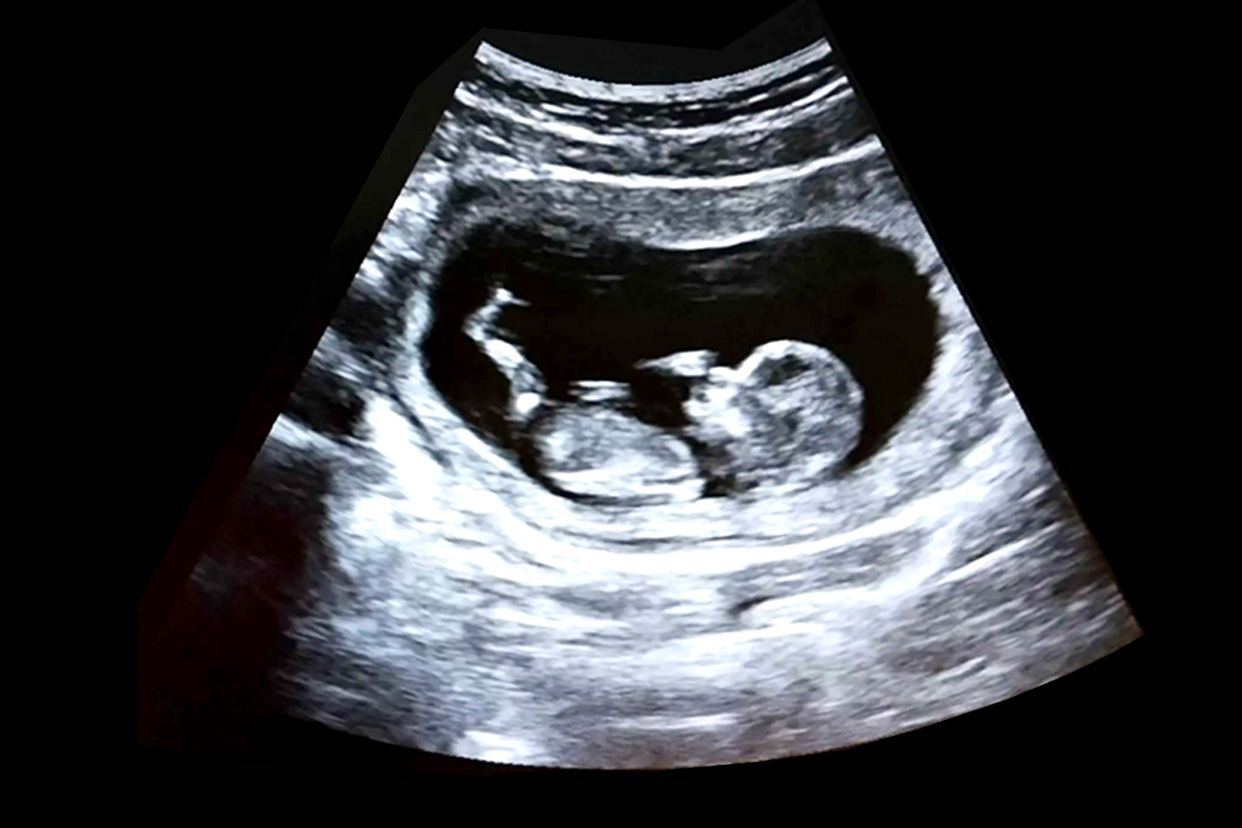 nt的胎儿图片可以看出脸型吗 nt的胎儿图片可以看出脸型吗女孩