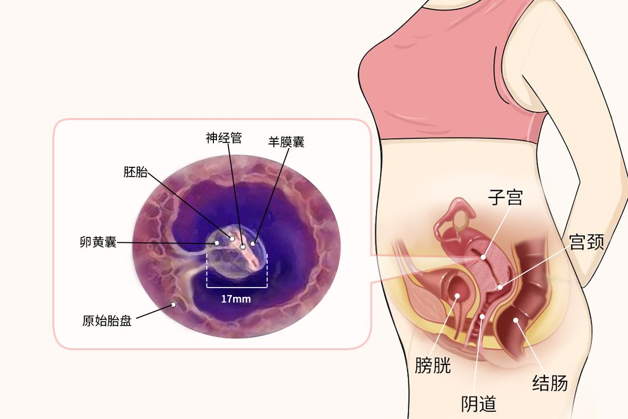 17mm孕囊有多大图片（孕囊17mm是多大）