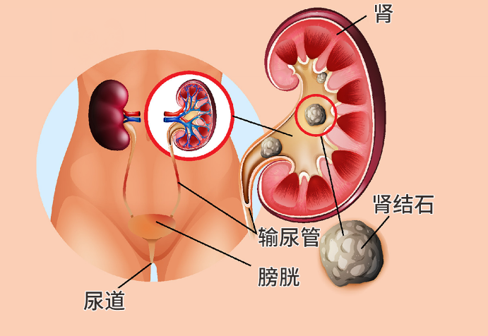 左肾结石一般在哪个位置图（左肾结石在什么位置图）