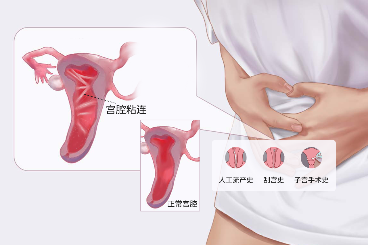 宫腔粘连和正常区别图 宫腔粘连和正常区别图片对比