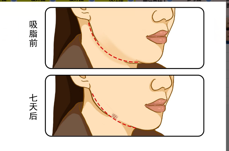 下颌缘吸脂7天恢复图 下颌缘抽脂多久才能恢复