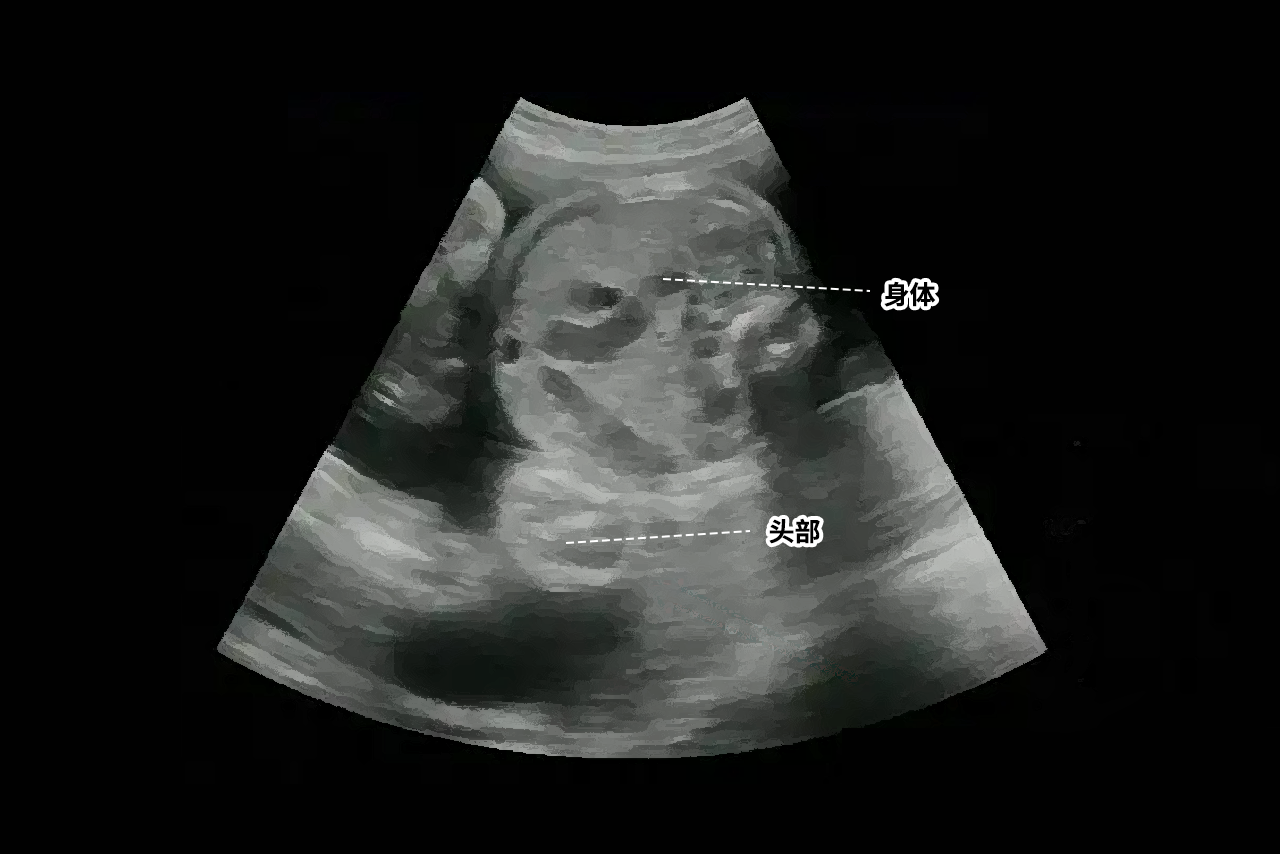 b超胎儿倒立着的图片 做b超宝宝倒立着