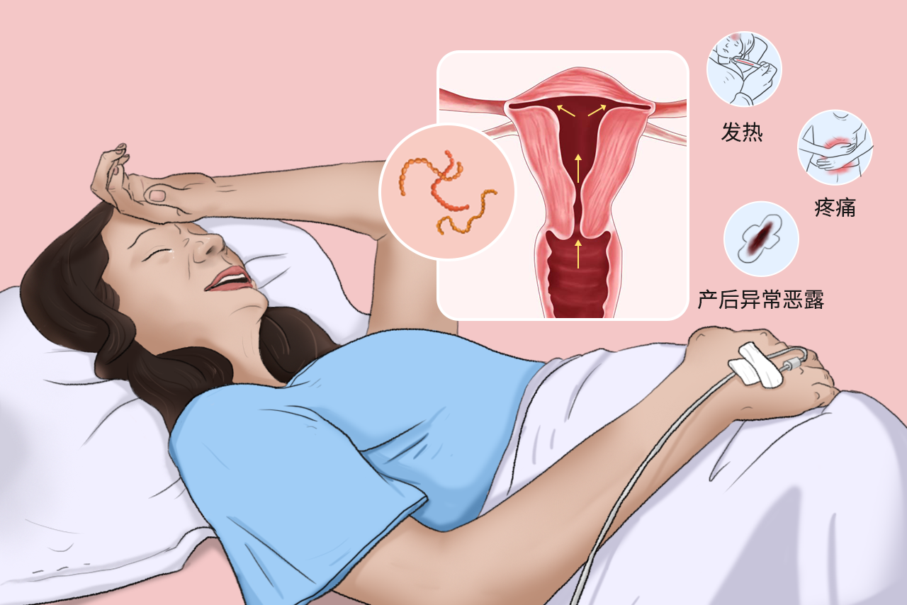 产褥感染的图片 产褥期感染的图片