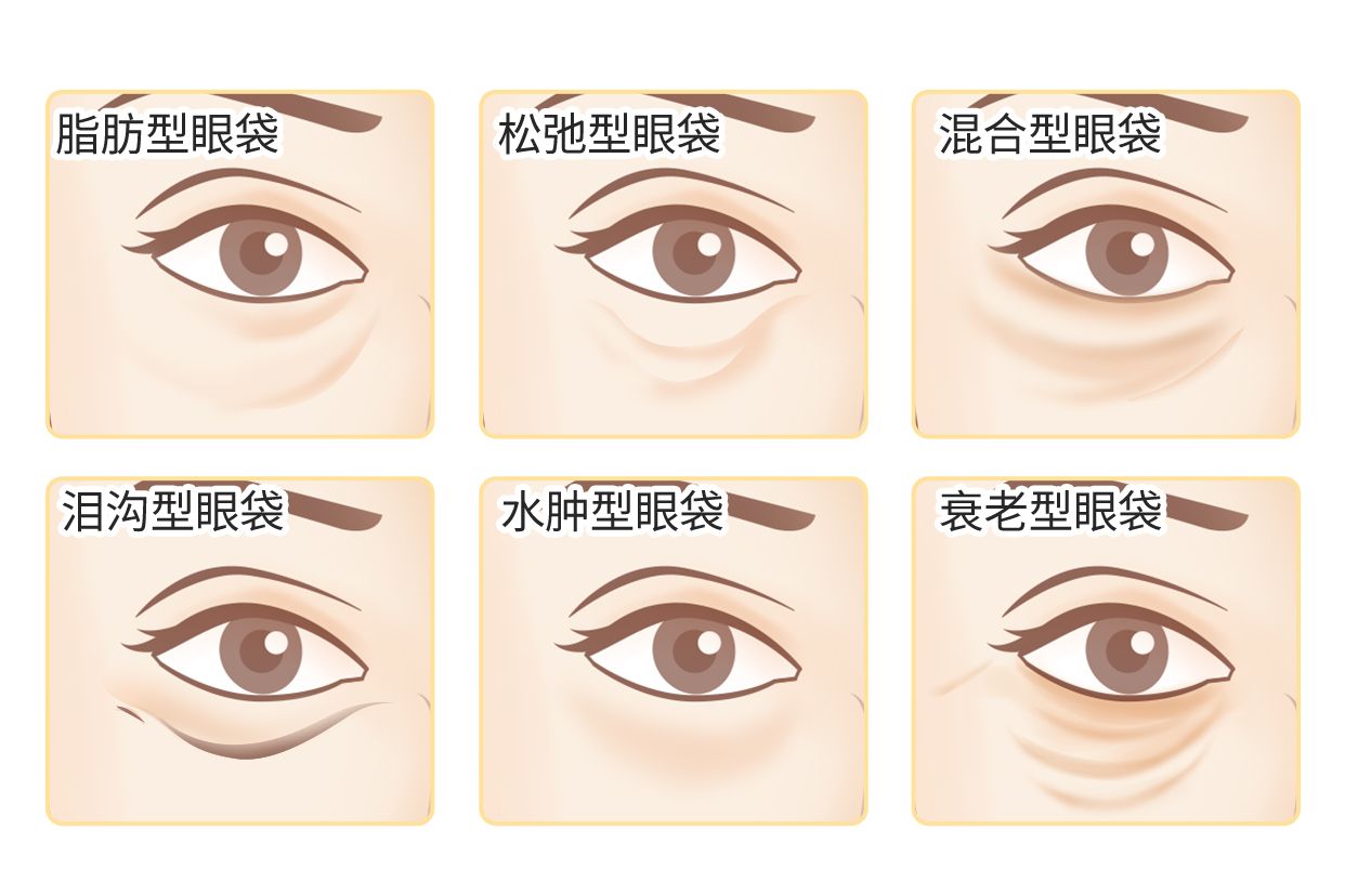 六种眼袋类型图片