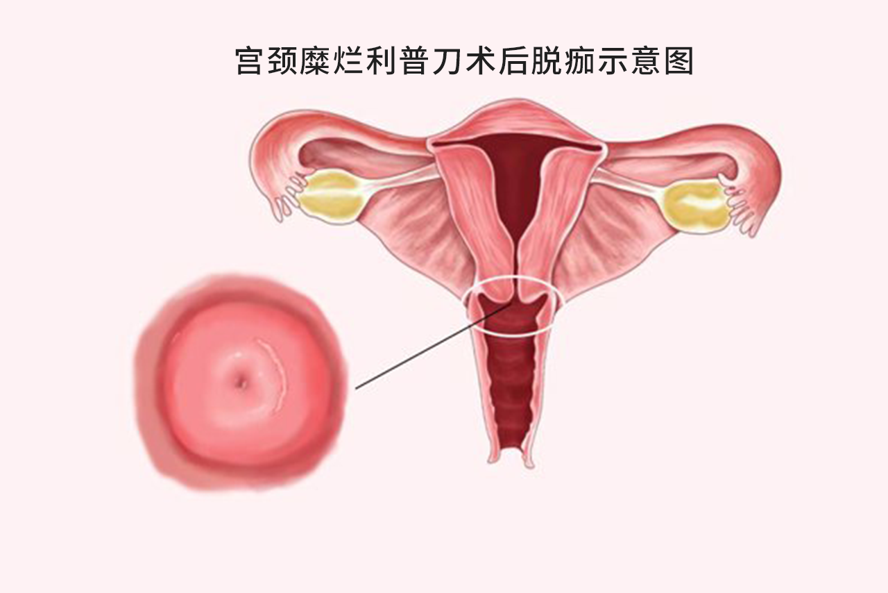 宫颈糜烂利普刀术后脱痂图片