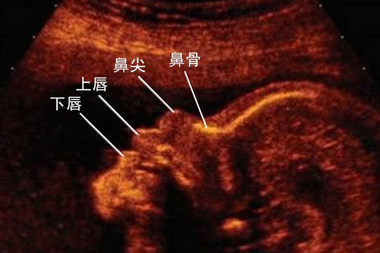 胎儿鼻骨超声切面图