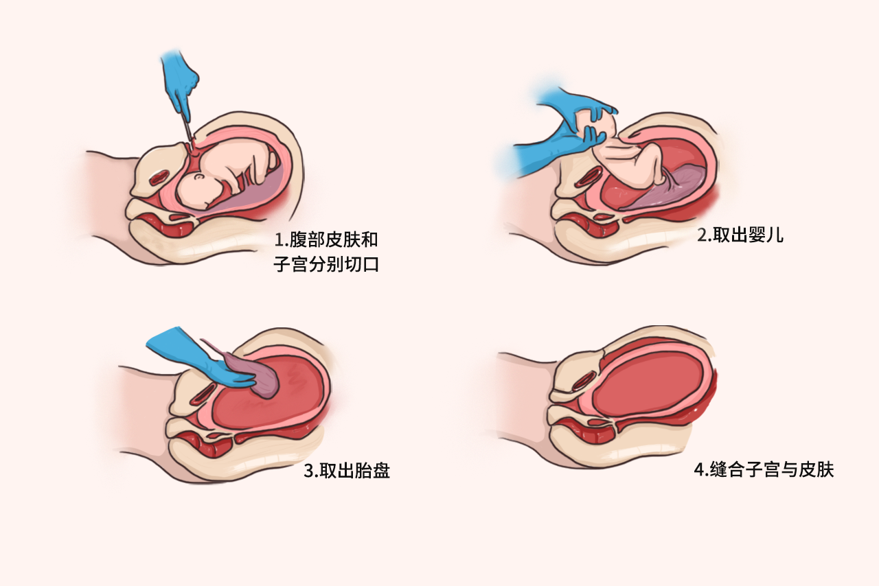 剖宫产步骤详解图解