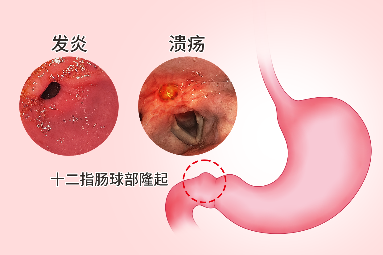 十二指肠球部隆起图片