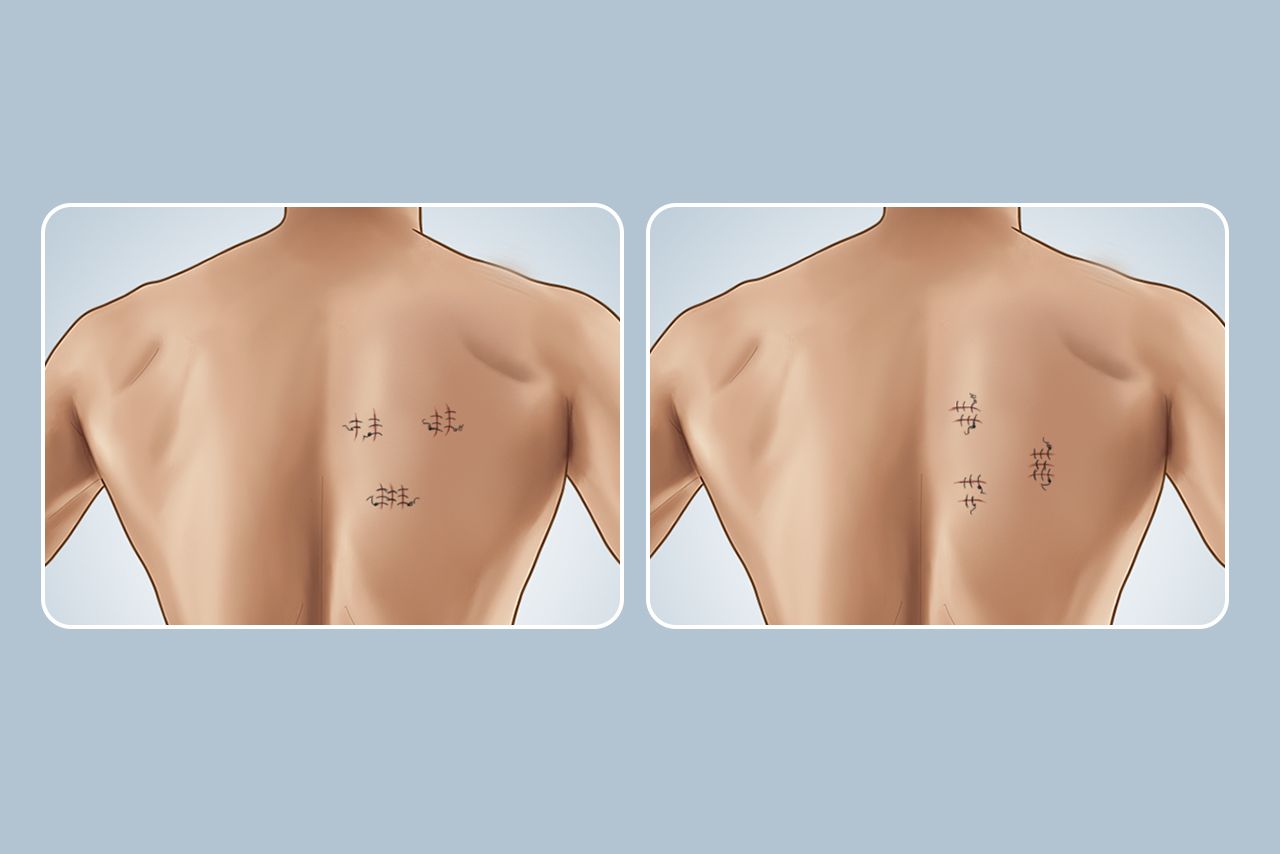 背部手术切口方向图片
