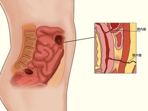 内瘘示意图（内瘘相关知识）