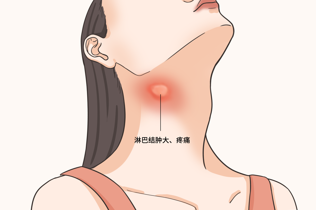 女性右侧颈部淋巴结肿大图片（左侧颈部淋巴结肿大图）