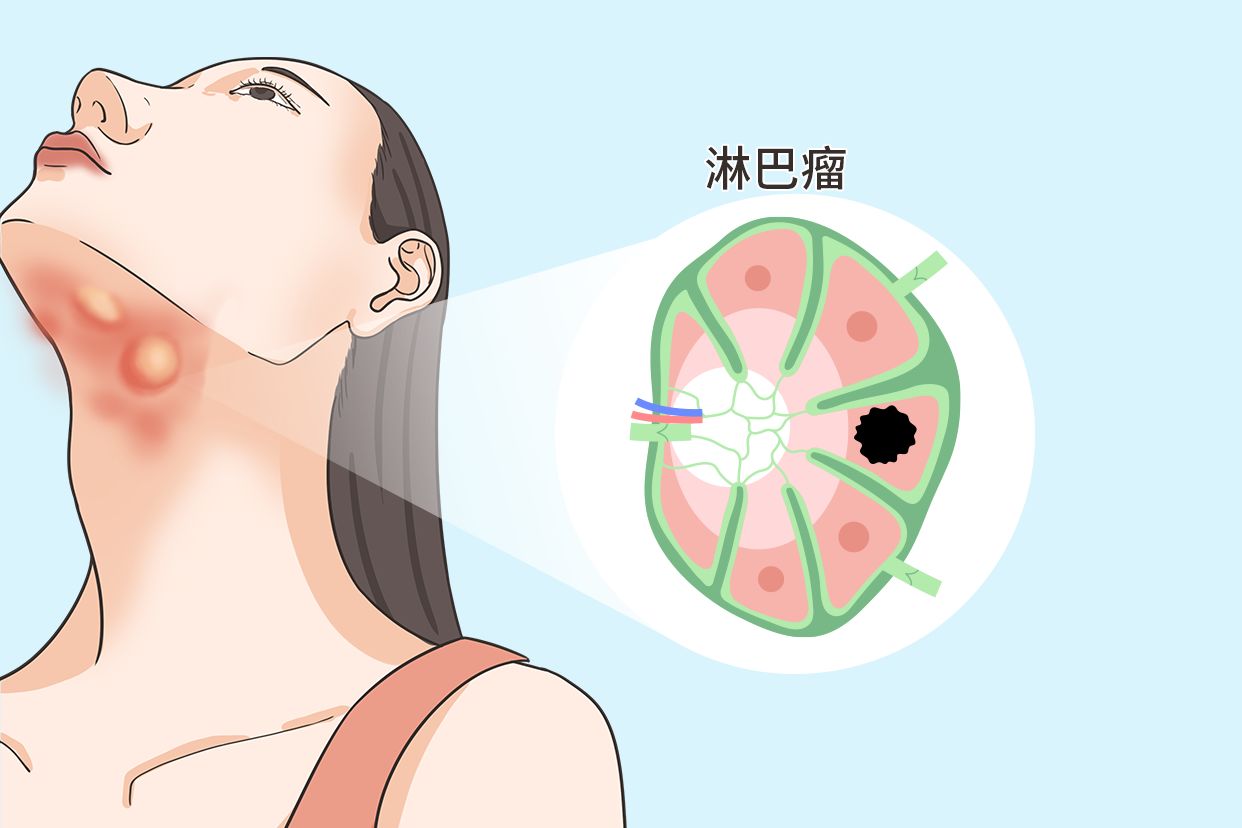 颌下淋巴瘤的图片（下颌淋巴癌图片）