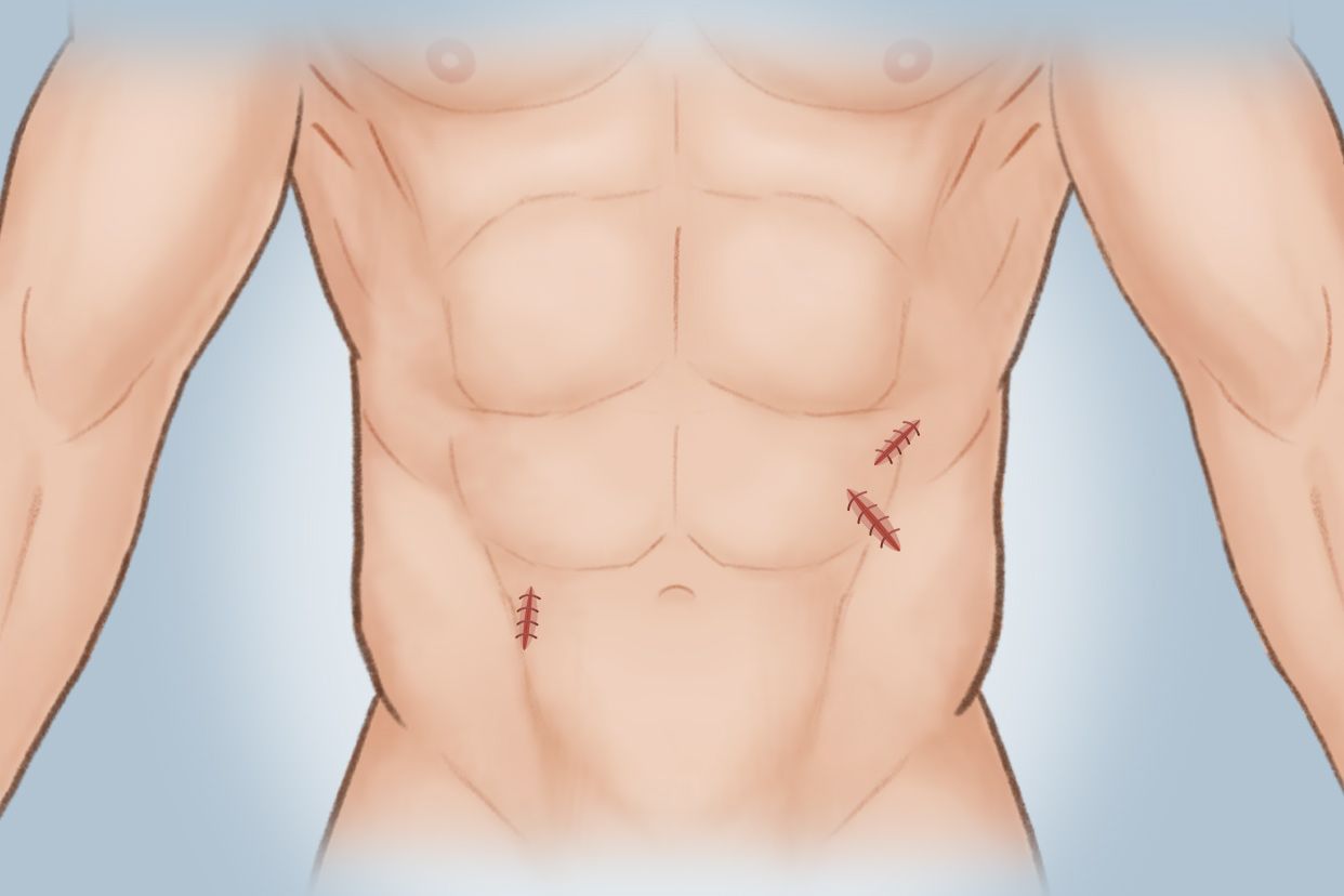 腹部补片手术后图片（腹部补片手术后图片大全）