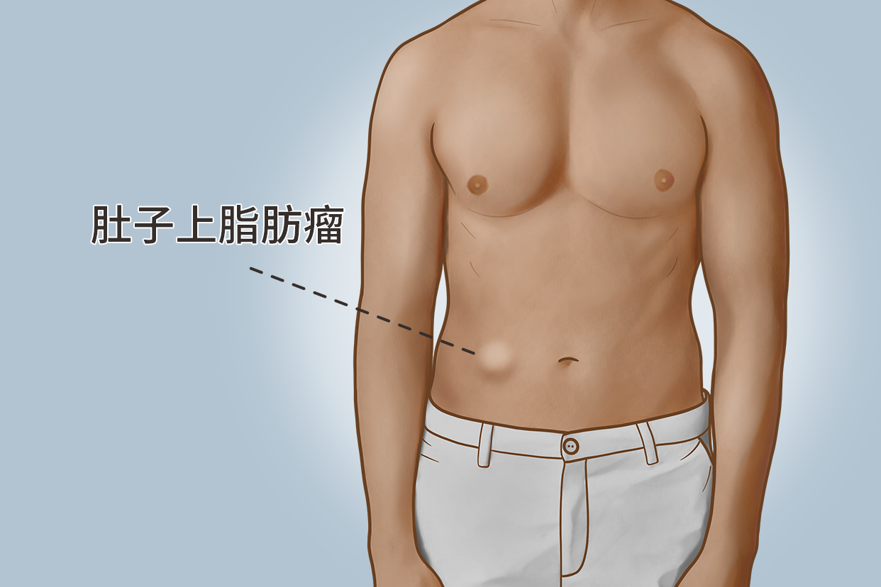 腹部多发脂肪瘤图片（腹部多发脂肪瘤图片大全）