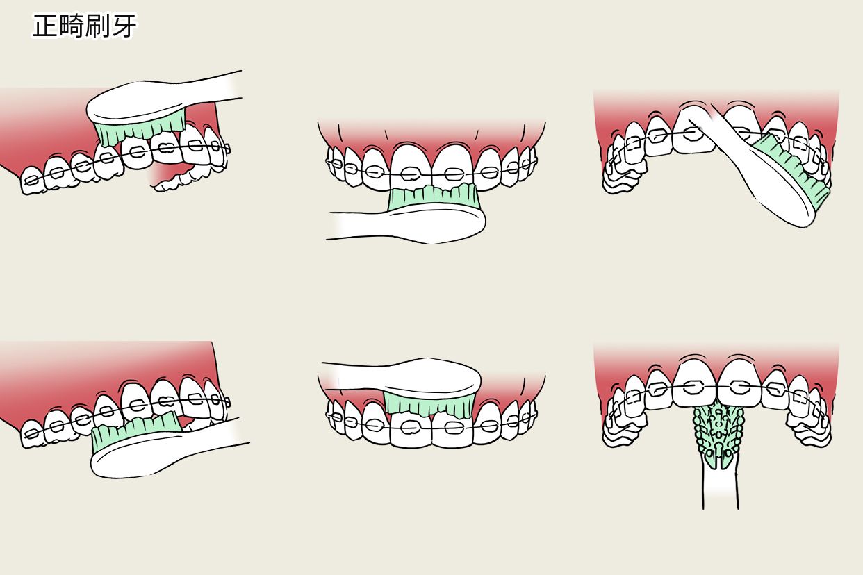 正畸刷牙步骤图片 正畸刷牙流程