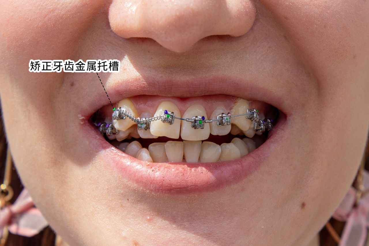 矫正牙齿金属托槽图片 矫正牙齿的金属托槽