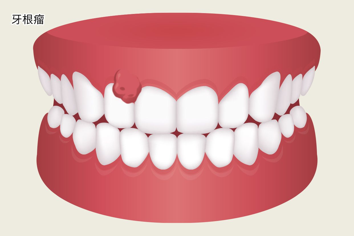 牙根瘤照片（牙齿根管瘤图片）
