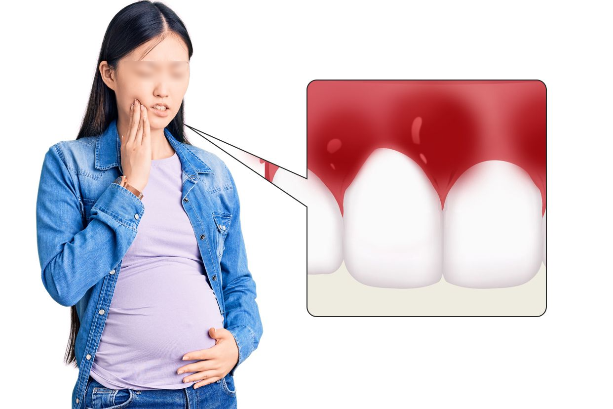 妊娠期牙龈炎图片（妊娠期牙龈炎症状图片）