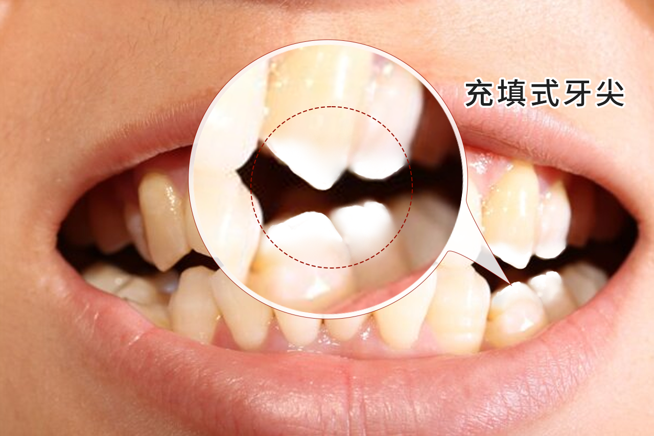 充填式牙尖示意图（充填式牙尖示意图高清）