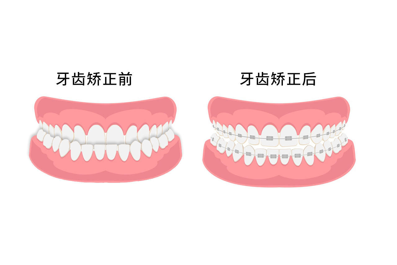 反颌牙齿矫正过程图片（牙齿反颌的矫正前后图片）