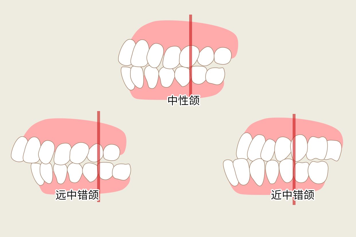 angle错颌分类图解（angle错颌分类法是怎样划分的）