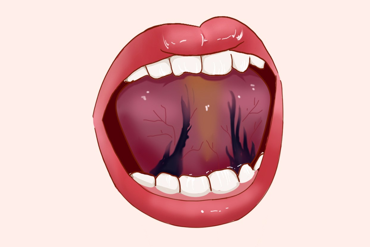 舌根淤堵图片 舌下淤堵图片