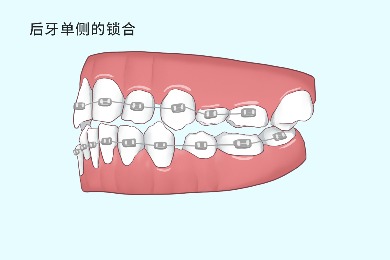 后牙单侧的锁合如何矫正图片（后牙锁颌的矫正图片）