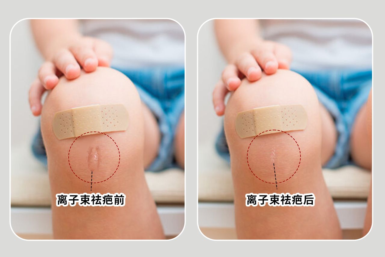 儿童离子束祛疤效果图 离子束祛疤做完的图片