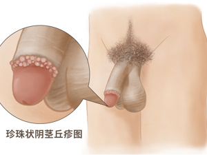 冠状沟皮脂腺异位图片 冠状沟皮脂腺异位图片