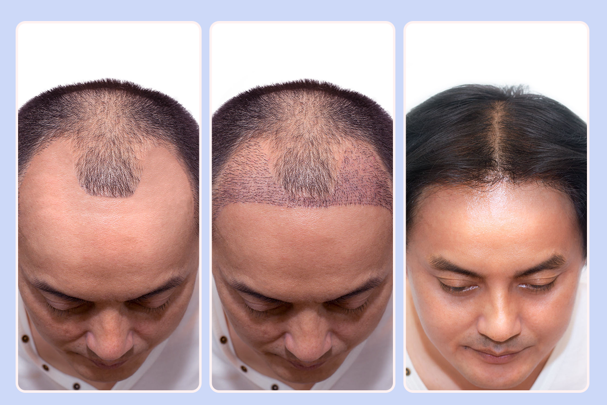 植发密度55和原生发密度的区别图片 植发密度55和原生发密度的区别图片对比