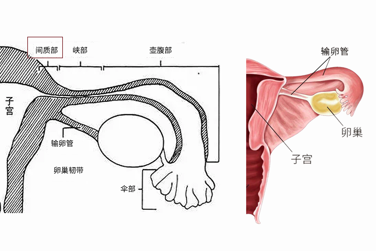 输卵管间质部图片 输卵管间质部图片位置示意图