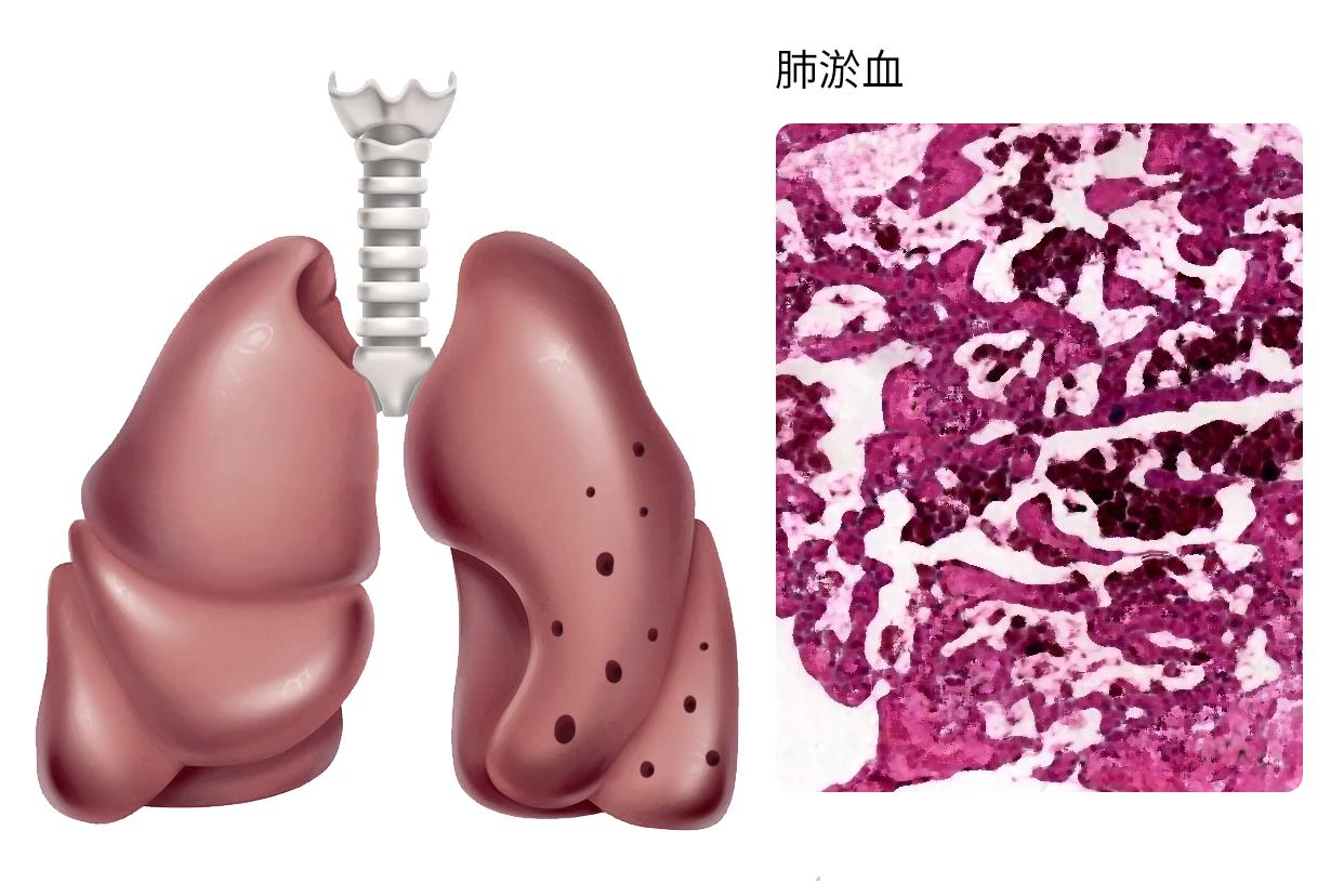 肺淤血图片 肺淤血图片 描述