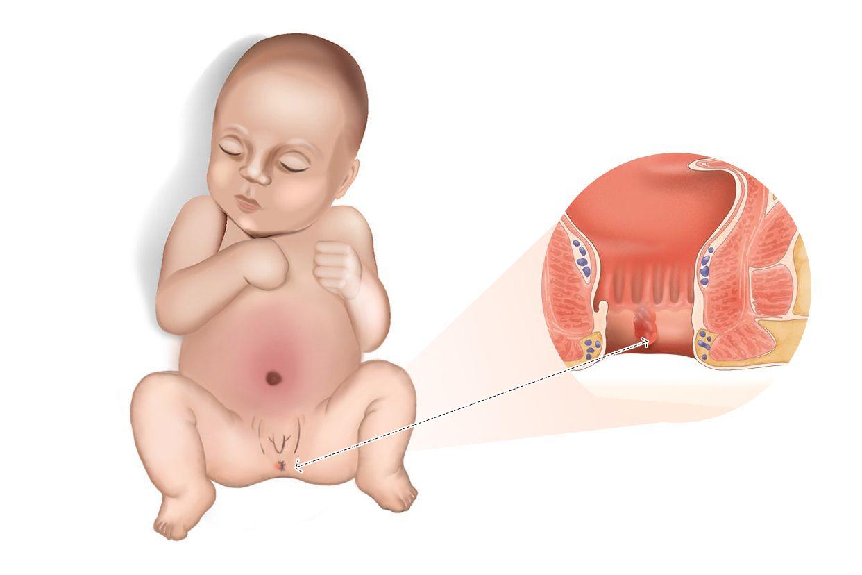 三个月婴儿肛门有肉疙瘩图片 三个月宝宝肛门那长了一颗硬是什么