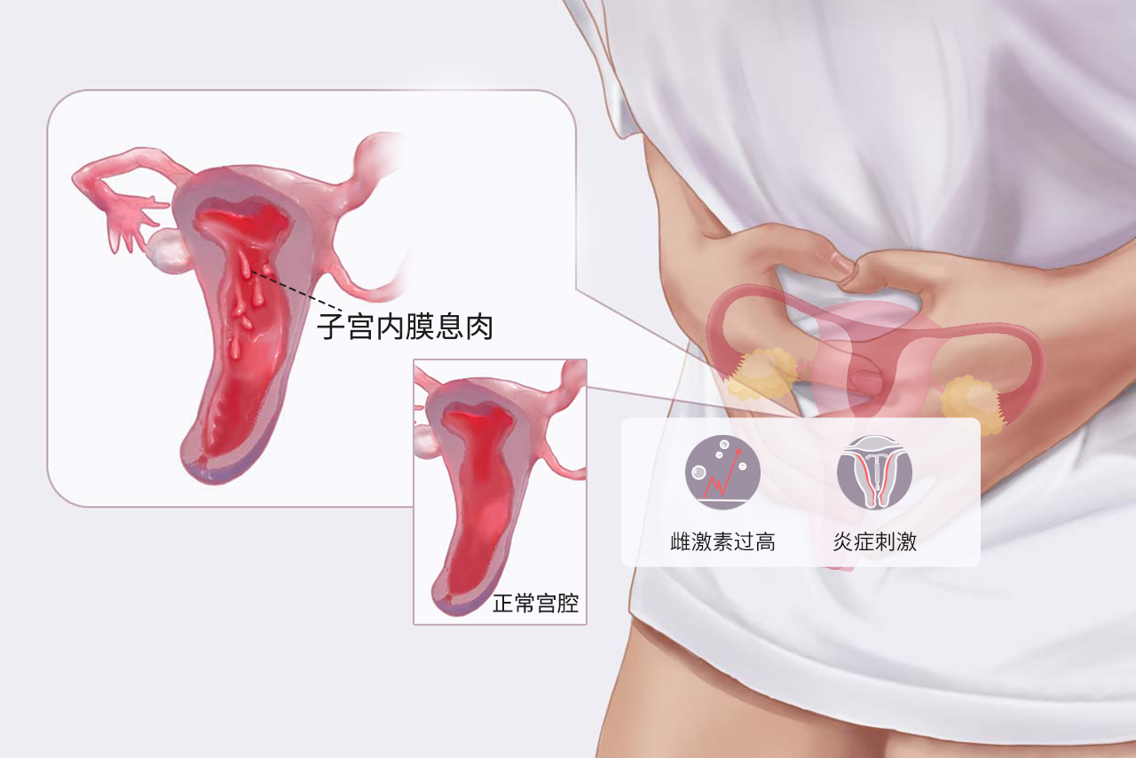 子宫内膜息肉长什么样 子宫内膜息肉什么症状