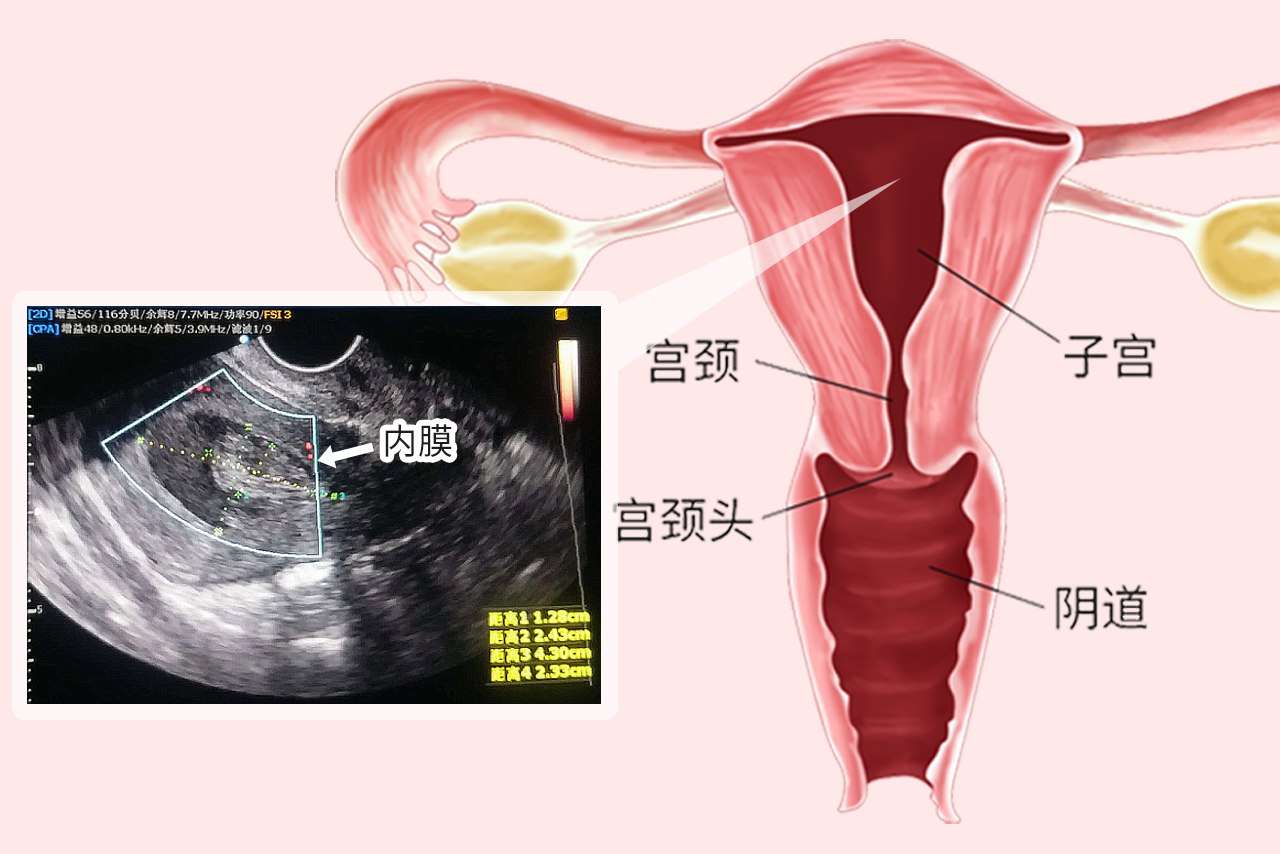 子宫内膜彩超图解（子宫内膜彩超图解）