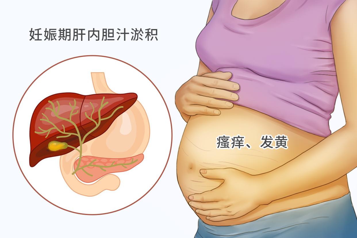 孕妇胆淤和湿疹的图片 孕妇胆淤和湿疹的图片大全